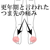 つま先の痛み