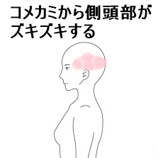 コメカミ　側頭部　頭痛