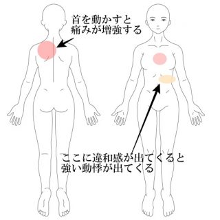 交通事故後遺症・動悸・肩こり・首コリ