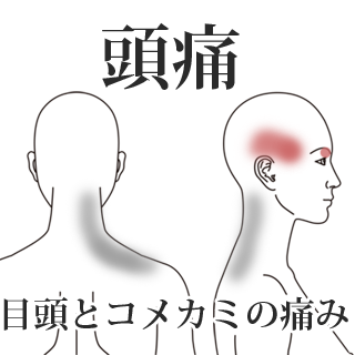 鍼による頭痛の改善例