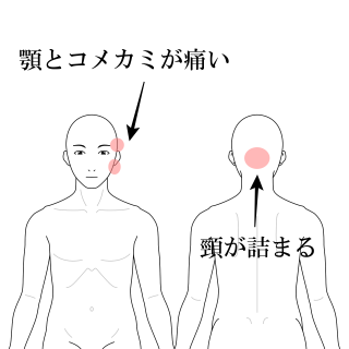 顎とコメカミが痛い