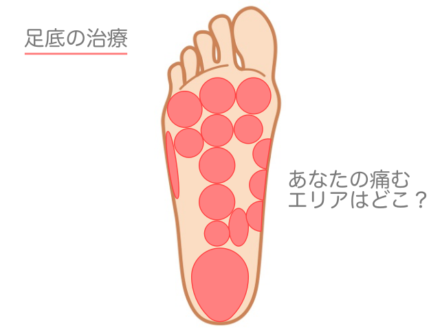 足底の治療　ツボで改善が期待できる「足裏の痛み」エリア